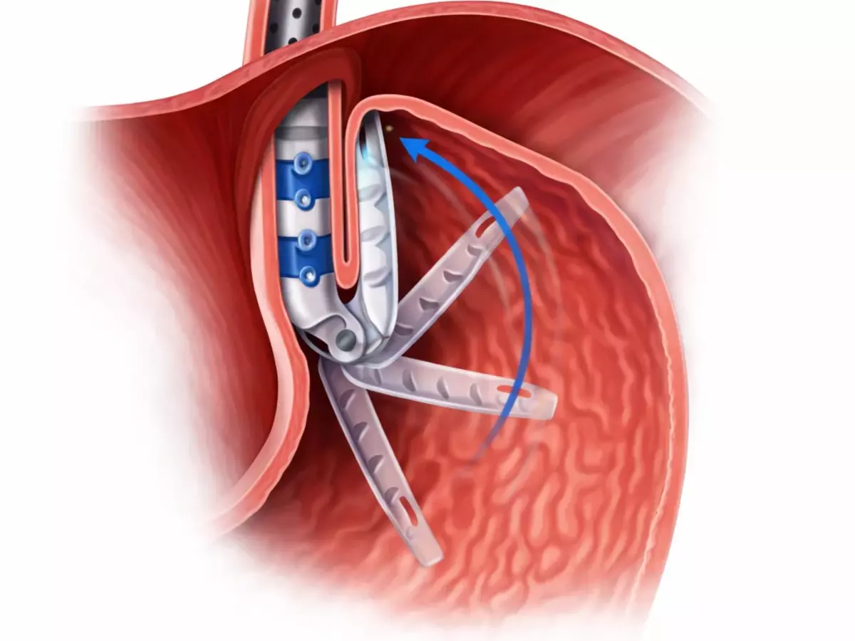 GERDx endoscopic suturing procedure illustration