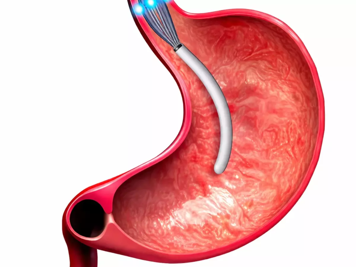Stretta radiofrequency energy procedure illustration